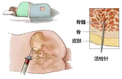 骨髓活检是骨髓活体组织检查术