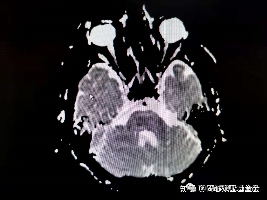 少见病因的脑梗死之真性红细胞增多症