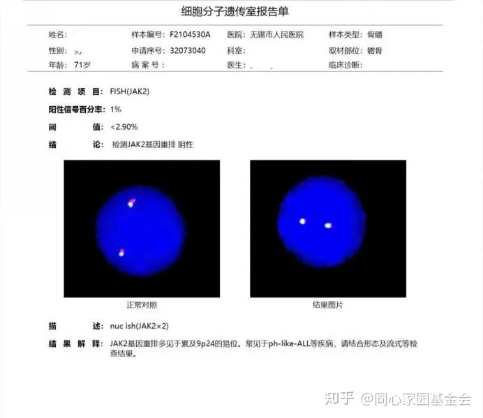 一例早期原发性骨髓纤维化的诊断历程