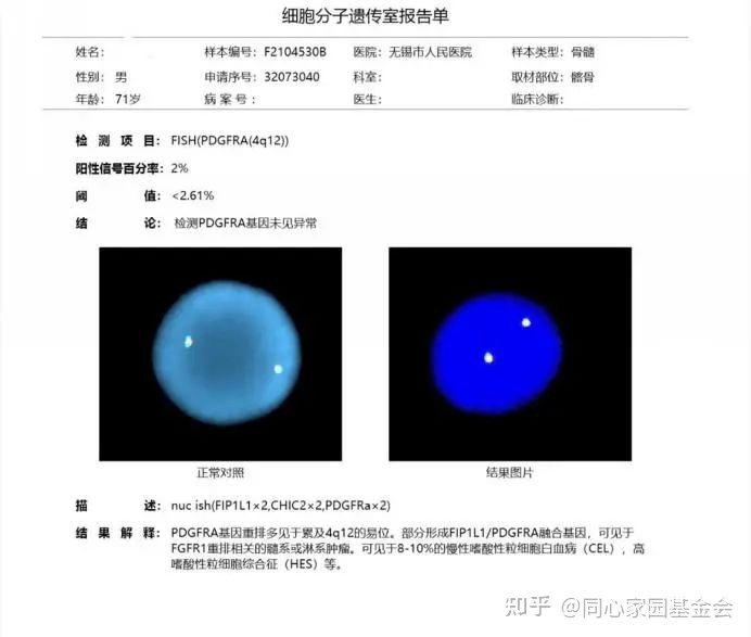 一例早期原发性骨髓纤维化的诊断历程