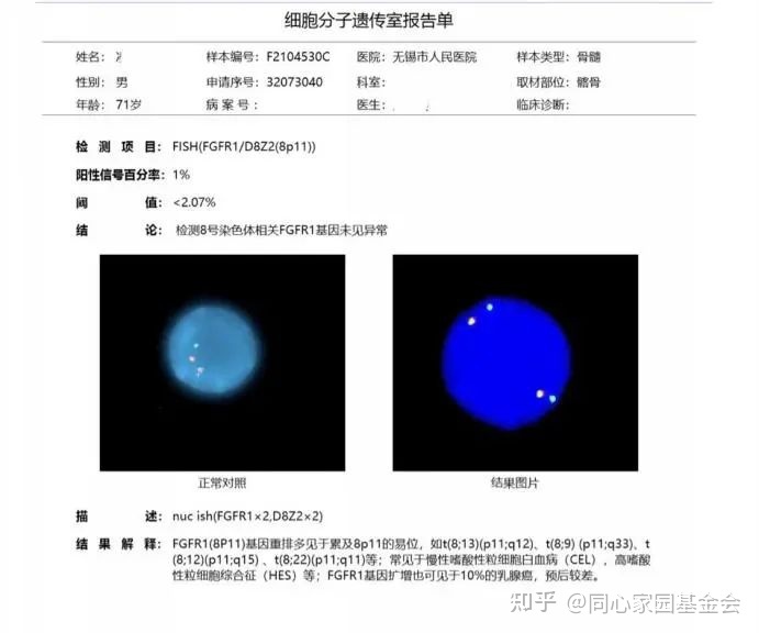 一例早期原发性骨髓纤维化的诊断历程