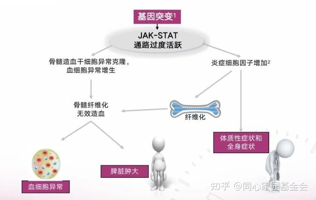 Q&A | 原发性骨髓纤维化（PMF）的预后，我们应该了解什么呢？